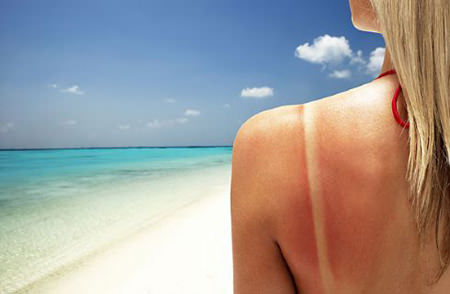 Come curare scottature da sole