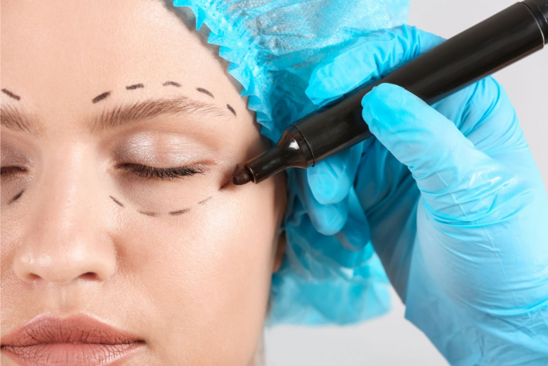 preparazione blefaroplastica chirurgia estetica viso donna