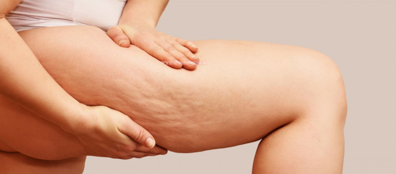 fossette cellulite coscia donna mani pelle buccia arancia