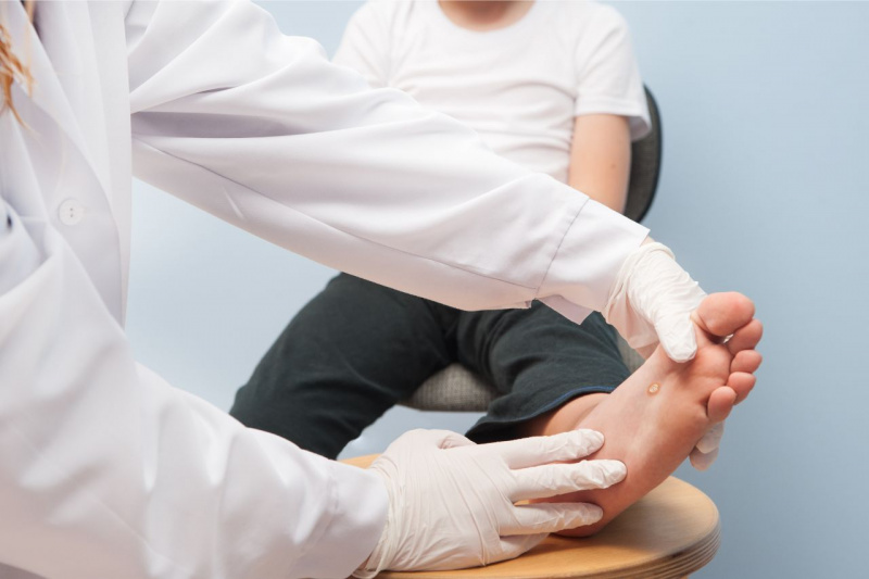 specialista medico professionista controlla pianta piede con verruca