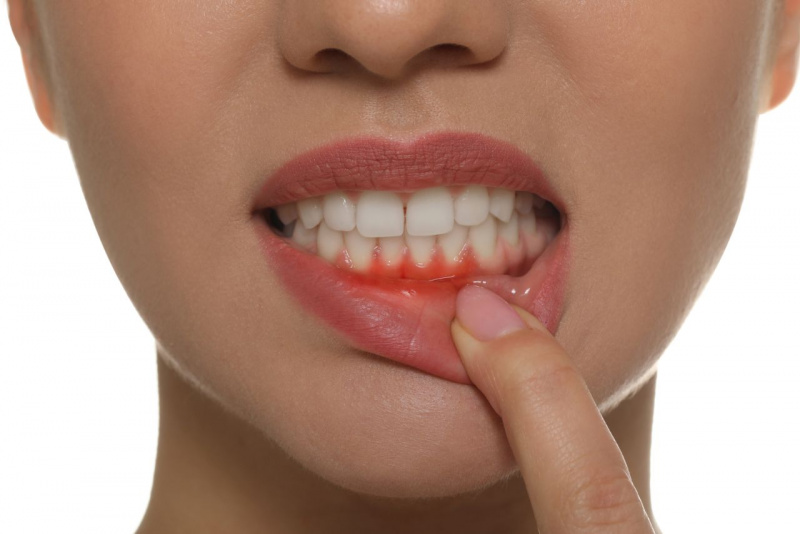 viso donna si guarda le gengive arrossate sanguinanti