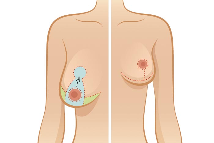 mastoplastica riduttiva