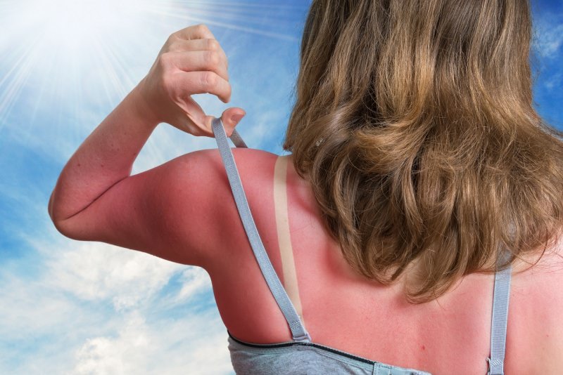 scottatura solare eritema segni sulle spalle donna reggiseno spalline abbronzatura sole