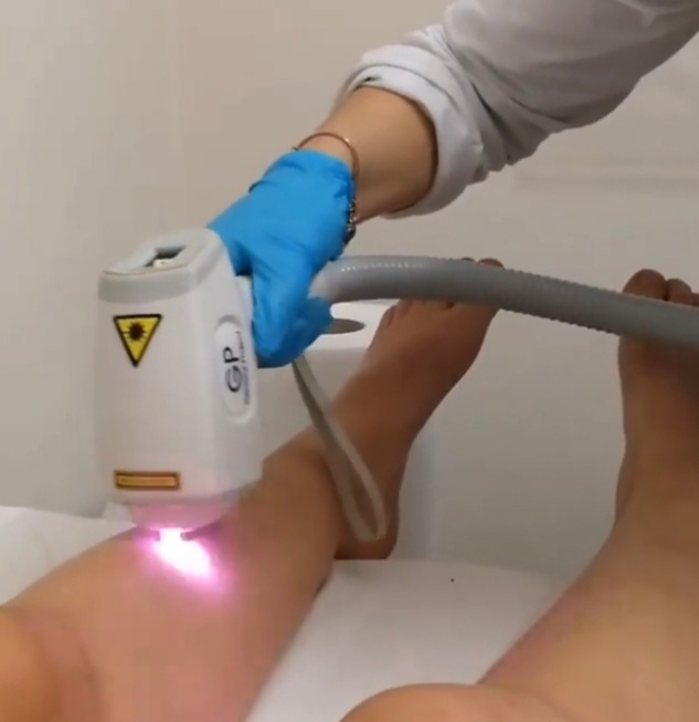 trattamento laser corpo bellezza